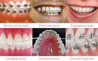 Что выбрать: прозрачные или металлические брекеты? Плюсы и минусы систем