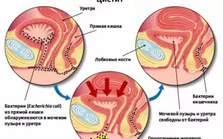 Воспаление мочевого пузыря у женщин – причины цистита