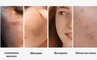 Сильная пигментация кожи: причины, особенности и эффективные методы борьбы