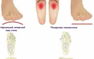 Как лечить поперечное плоскостопие