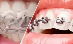 Современные методы выравнивания зубов: брекеты, элайнеры и другие решения