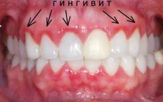Профессиональное лечение десен у стоматолога: этапы, методы и цены