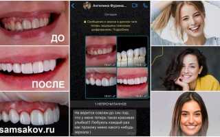 Эстетическая стоматология: от отбеливания до виниров — что выбрать для идеальной улыбки