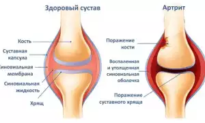 Артрит – коварная болезнь суставов. Причины, симптомы, лечение