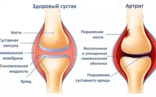 Артрит – коварная болезнь суставов. Причины, симптомы, лечение