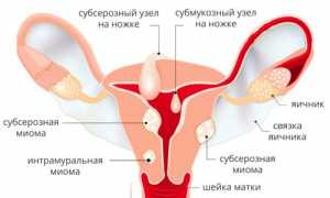 Миома: что это? Диагностика, лечение
