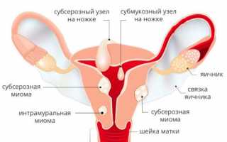 Миома: что это? Диагностика, лечение