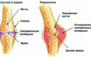 Ревматизм суставов: симптомы и лечение недуга