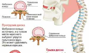 Межпозвоночная грыжа – причины, симптомы, лечение