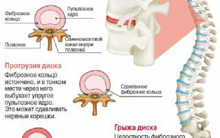 Межпозвоночная грыжа – причины, симптомы, лечение