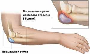Бурсит локтевого сустава: симптомы и лечение
