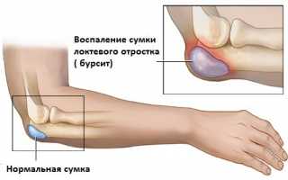 Бурсит локтевого сустава: симптомы и лечение