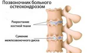 Остеохондроз – причины недуга, симптомы и лечение