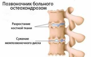 Остеохондроз – причины недуга, симптомы и лечение