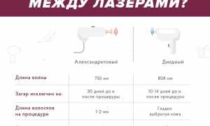 Диодный, александритовый или неодимовый: какой лазер выбрать для эпиляции?