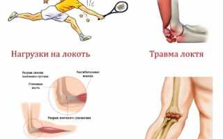Боль в локтях: почему болит локоть