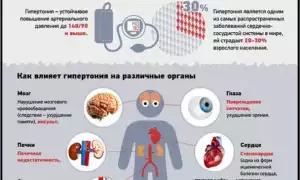 Гипертония – причины, симптомы, лечение и группы риска