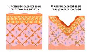 Гиалуроновая кислота – почему о ней так много говорят?