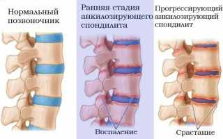 Болезнь Бехтерева: симптомы и лечение
