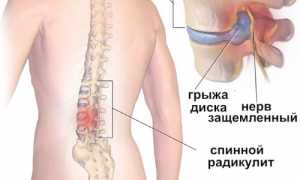 Радикулит поясничный: симптомы и лечение