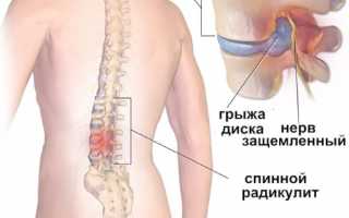 Радикулит поясничный: симптомы и лечение