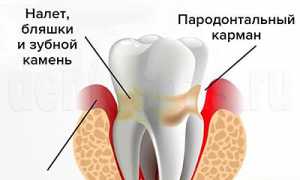 Пародонтит – что это такое? Симптомы, лечение, профилактика