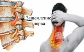 Защемление нерва – что это, как лечить