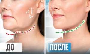 Как убрать обвисшие щеки – домашний лифтинг, упражнения, маски