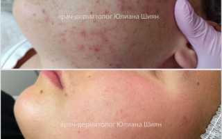 Как не навредить коже при борьбе с прыщами: распространённые ошибки и проверенные решения