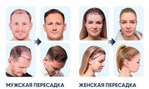 Выпадение волос – причины и лечение. Как бороться с облысением