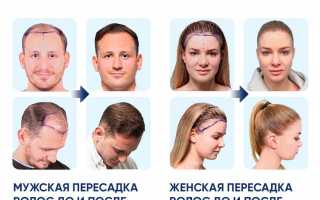 Выпадение волос – причины и лечение. Как бороться с облысением