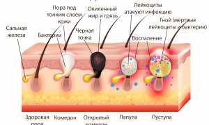 Черные точки на коже – все, что нужно о них знать