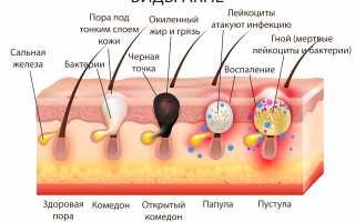 Черные точки на коже – все, что нужно о них знать