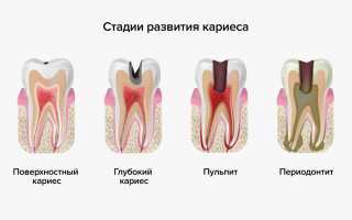 Кариес — что это такое и как его избежать
