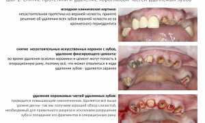 Почему не стоит откладывать удаление проблемного зуба: возможные последствия и риски