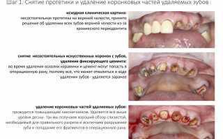Почему не стоит откладывать удаление проблемного зуба: возможные последствия и риски