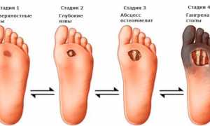 Что такое диабетическая стопа: лечение