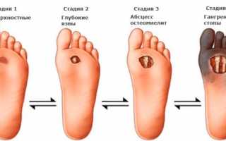 Что такое диабетическая стопа: лечение