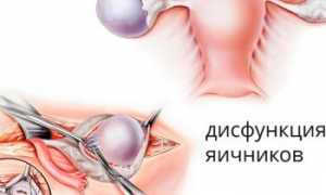 Дисфункция яичников – что это такое и чем опасно для женщины