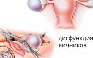 Дисфункция яичников – что это такое и чем опасно для женщины
