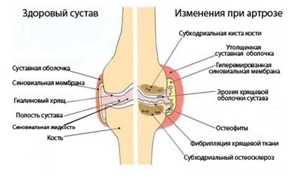 Артроз коленного сустава (гонартроз): симптомы и лечение