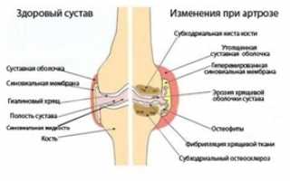Артроз коленного сустава (гонартроз): симптомы и лечение