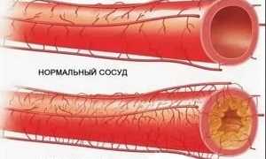 Как очистить сосуды с помощью народных средств