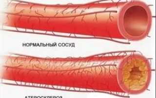 Как очистить сосуды с помощью народных средств