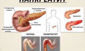 Панкреатит — заболевание поджелудочной железы
