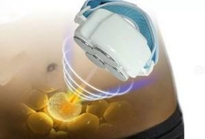 Кавитационная липосакция 