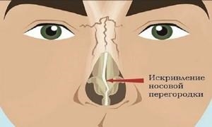 Искривление носовой перегородки 