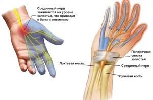 Патологические причины онемения 