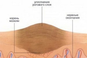 vrosshaya-mozol
