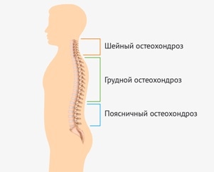лечение остеохондроза